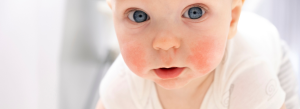 Bebê com dermatite